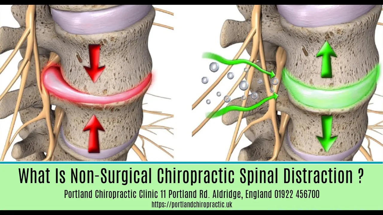 Bulging Disc Treatment